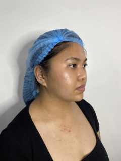 Botox