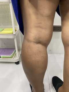 Sclerotherapy