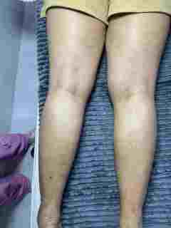 Stretchmarks Removal